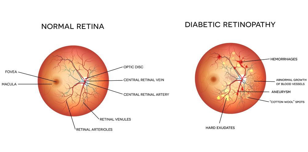 Cataract surgery