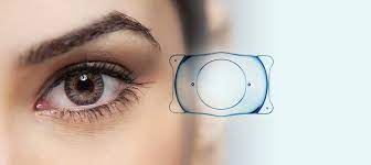 Cataract surgery